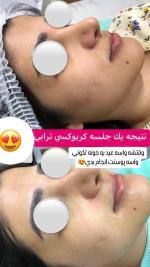 میکرونیدلینگ کربوکسی تراپی co2 (سفید کننده پوست )